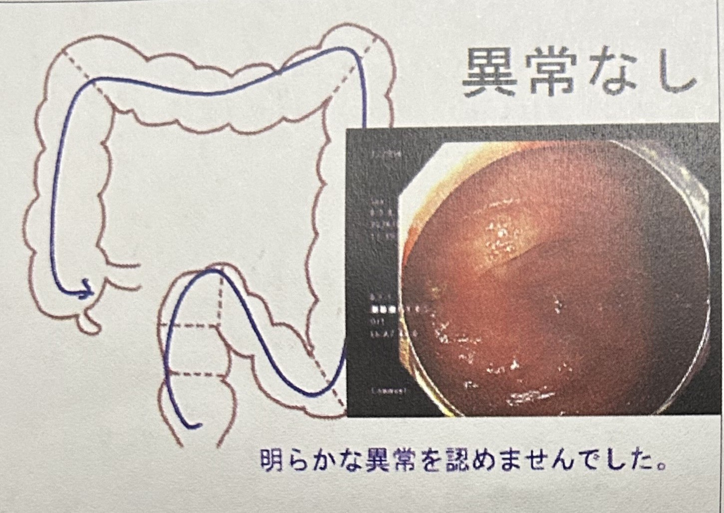大腸内視鏡検査の結果説明書。「異常なし」「明らかな異常を認めませんでした」と記載されている
